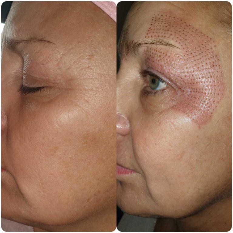 Plasma Facelift Heavenly Beauty